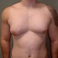 Ginecomastia nella sindrome di Klinefelter