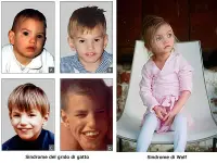A sinistra: gruppo dibambini di diverse età affetti da sindrome del grido del gatto. A destra bambina con sindrome di Wolf